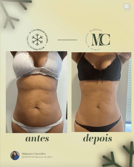 Antes e depois de criomodelagem na Clínica MC em Curitiba — resultado 1