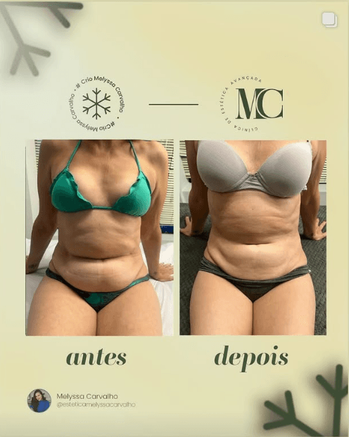 Antes e depois de criomodelagem na Clínica MC em Curitiba — resultado 2