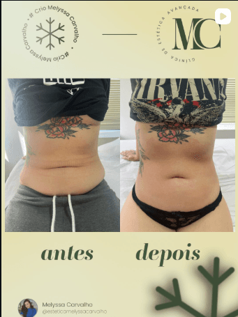 Post da MC com antes e depois de criomodelagem corporal nos flancos