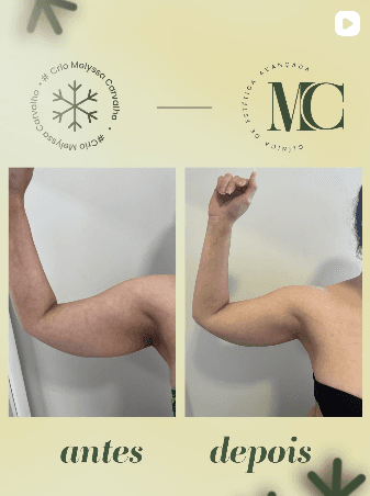 Antes e depois de criomodelagem na Clínica MC em Curitiba — resultado 15
